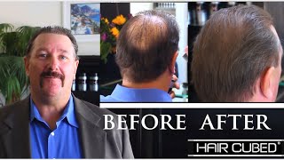 After Hair Transplant With HairCubed Fibers Spray Call 18007191008 [upl. by Mailand857]