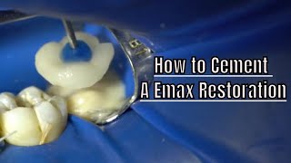 How to Lute a Emax Restoration  Crown [upl. by Ainelec433]