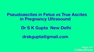 Pseudoascites vs True Ascites in Fetus on Ultrasound [upl. by Ramalahs61]