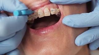 How to clean your around your braces with Gill from Elmsleigh House Dental Clinic [upl. by Bittner]