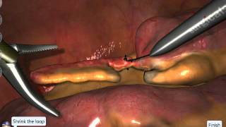 LapSim Appendectomy Loop Technique [upl. by Blondell]