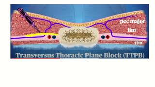 Anatomy of Intercostal Nerve Block A Comprehensive Guide [upl. by Onaivatco]