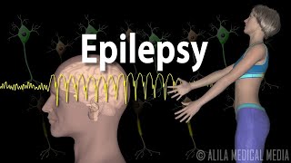 Epilepsy Types of seizures Symptoms Pathophysiology Causes and Treatments Animation [upl. by Lundgren]