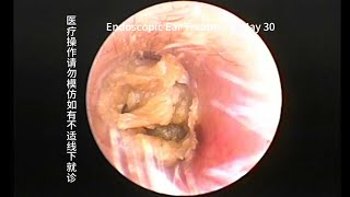 Cholesteatoma that requires regular followup and regular cleaning [upl. by Bard]