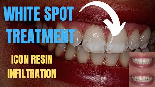 White Spots Fluorosis Smile Transformation  Before and After Procedure with ICON Resin Infiltration [upl. by Siramed]