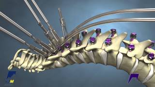 Correcting Kyphosis with the MESA Rail™ Deformity Spinal System [upl. by Otrebireh]