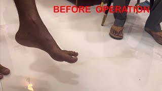 Before Operation and 2 Months after Operation Foot deformity Foot drop [upl. by Nauqes224]