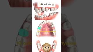 Second premolars extraction orthodontie kieferorthopädie orthodontics ortodonzia ortodoncia [upl. by Atinrahc877]