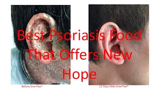 EnerFlex Nutrition  Case Studies on Scalp Plaque and Erythrodermic Psoriasis Updated 42016 [upl. by Melisa]