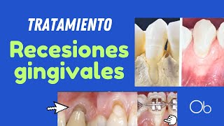 RECESIONES GINGIVALES causas y tratamiento encías retraídas [upl. by Moises]