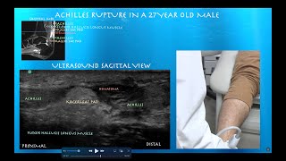 Ultrasound of an Achilles Tendon Rupture with Kagers Fat Pad Interposition in a 27 Year Old Male [upl. by Nira355]