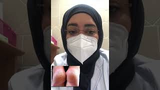 تقرن جلد اليدين والقدمين PalmoPlanter keratoderma [upl. by Annoda]