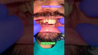 Full Mouth Dental Implant fullmouth implants teeth shorts smile song [upl. by Arvind]