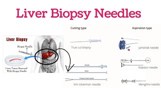 Liver Biopsy  Liver Biopsy Needles  Indications For Liver Biopsy  Types of Liver Biopsy [upl. by Addiego]