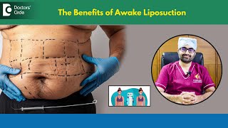 Is quotAWAKE LIPOSUCTIONquot safeKnow how Awake Liposuction works DrAniketh VenkataramDoctors Circle [upl. by Bartholomeo]