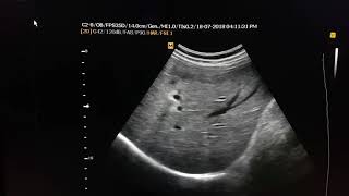 Liver Cirrhosis Sonography [upl. by Yelbmik438]