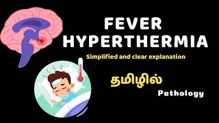 Fever amp Hyperthermia patho physiology in Tamil Simplified and Clear explanation [upl. by Haelam]