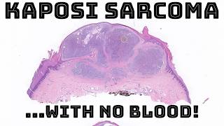 Tricky Nodular Kaposi Sarcoma  NO extravasated blood pathology dermatology dermatopathology [upl. by Cos]