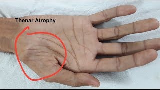 Thenar Atrophy in Motor Neuron Disease [upl. by Argella599]