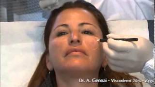 Viscoderm 20 30 Gneedle Dr Gennai [upl. by Thaddaus]