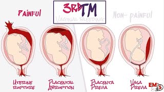 APH Antepartum haemorrhage [upl. by Kulda]