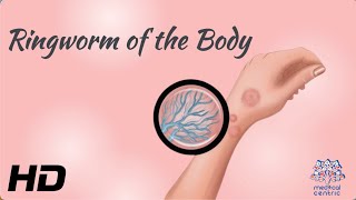 Ringworm of the Body What You Need to Know to Keep Your Skin Healthy [upl. by Derward348]