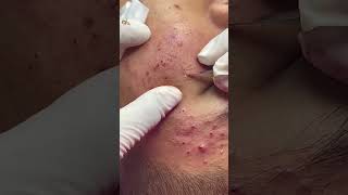 Best Pimple Popping 04 beautiful blackheads sacdepspa [upl. by Earb154]