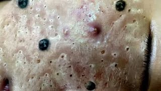 Extreme Blackhead Removal at Nasa Spa  Relax Every Day With Sac Dep Spa 2023 9755 [upl. by Esbenshade209]