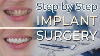 Dental Implant Surgery  Step by Step 67 Gluing the Onlay 13 Anterior Canine Guidance [upl. by Aenej]