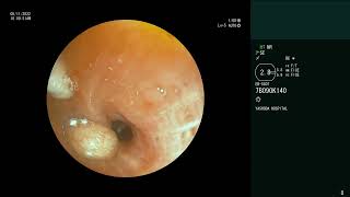 Endobronchial Carcinoid  Bronchoscopic retrieval [upl. by Auqinehs]