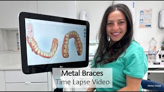 Metal Braces  Time Lapse  London  Whites Dental [upl. by Annawik]