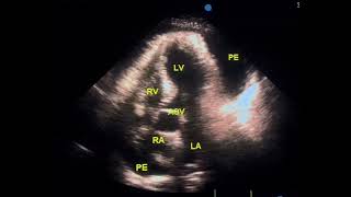 Tamponade echo to drahmadmirdamadisil3PboCd7Rn3QHdb [upl. by Zaraf]