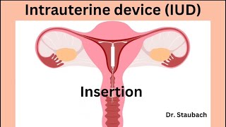 IUD Insertion What You NEED To Know ACTUAL FOOTAGE [upl. by Dichy]