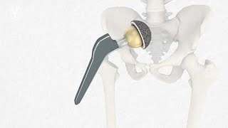 Implantation einer Hüftgelenk Endoprothese und Leben mit einem künstlichen Hüftgelenk [upl. by Ally]