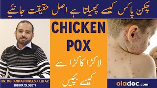 Chicken Pox Symptoms Treatment  Chicken Pox Ka Ilaj In Urdu  Lakra Kakra Ka Elaj  Red Rash Relief [upl. by Grassi613]