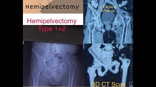 Hemipelvectomy  Life with or without Hip Joint [upl. by Llednahs]