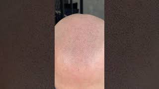 Healed scalpmicropigmentation 2nd session one more to go scalpnation hairtattoo [upl. by Arit371]