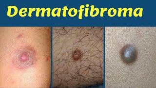 Dermatofibroma treatment hard bump on leg  चमड़ी में सख़्त गाँठ का कारण  इलाज  Dr Uttam Lenka [upl. by Ccasi49]