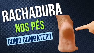 Como combater rachadura nos pés Por Luiz Gameiro dermatologista [upl. by Whitebook774]