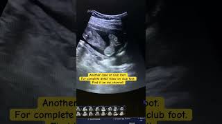 Inverted club foot case ultrasound baby usgshorts [upl. by Airdni]