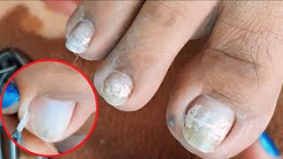 Satisfying Ingrown Toenail Removal  Dry Skin  Pedicure 121 [upl. by Sivrep548]