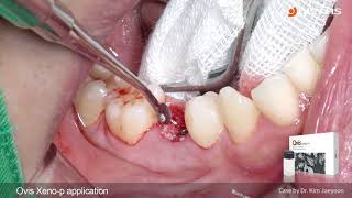 DENTIS Implant Lower premolar immediate implant placement amp immediate loading [upl. by Charil]