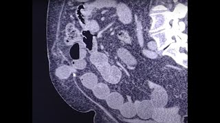 Paraumbilical hernia  incarcerated causing small bowel obstruction [upl. by Odnomar555]