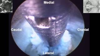 Percutaneous Endoscopic Interlaminar Lumbar Discectomy PEILD by Dr Hyeun Sung Kim01 [upl. by Anasus380]