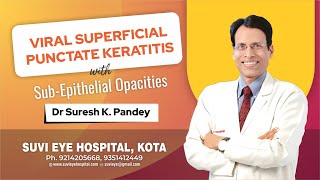 Viral Superficial Punctate Keratitis with SubEpithelial Opacities at SuVi Eye Institute Kota India [upl. by Stanfill]