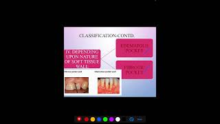 PERIODONTAL POCKET [upl. by Koziarz]