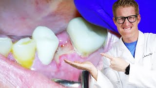 Dentist Explains TOOTH PAIN AFTER EXTRACTIONS Throbbing Dry Socket amp Aching For Days After [upl. by Polash]