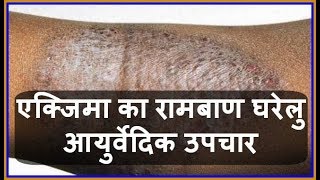 Health Tips एक्जिमा का रामबाण घरेलु आयुर्वेदिक उपचार  Charm Rog  Eczema ka Gharelu Upchar [upl. by Holms]