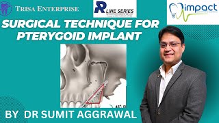 SURGICAL TECHNIQUE FOR PTERYGOID IMPLANT  BY DR SUMIT AGGRAWAL  part 2 [upl. by Remot]