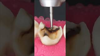 Root Canal Treatment proceduresubscribeytshorts [upl. by Sima]